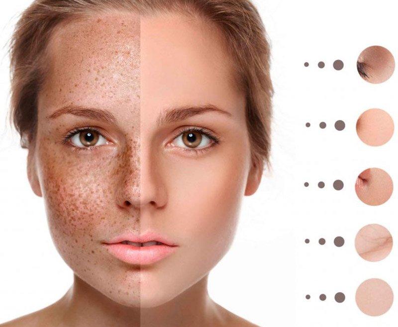 Tàn nhang là một tình trạng tăng sắc tố da khá phổ biến (Nguồn: Internet)