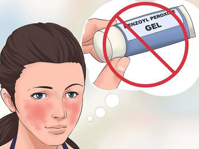 Sử dụng Benzoyl Peroxide trị mụn có thể không cần đến sự kê đơn của bác sĩ. (Nguồn: Internet)