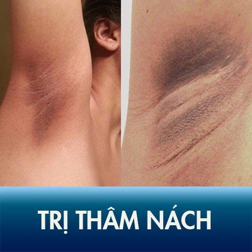 Thâm nách ảnh hưởng rất nhiều đến cuộc sống (Nguồn: Internet) Thâm nách ảnh hưởng rất nhiều đến cuộc sống (Nguồn: Internet)