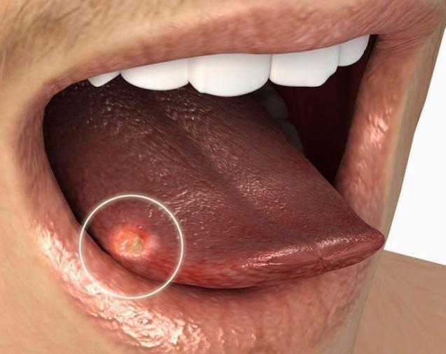 Một nốt loét nhỏ ở lưỡi cũng có thể là dấu hiệu của ung thư lưỡi (Ảnh: Internet)