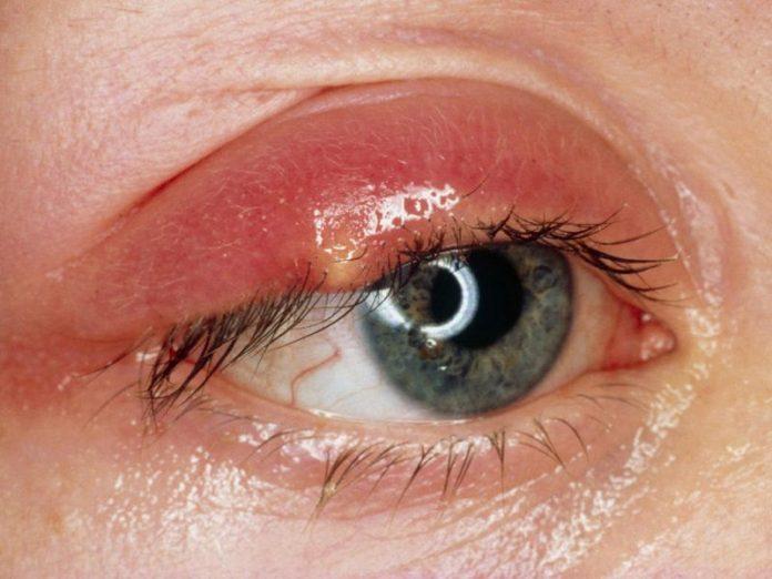 Ung thư mắt là một dạng ung thư hiếm gặp. (Ảnh: Internet)