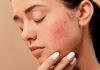 Skincare trị mụn ẩn hiệu quả chỉ trong 6 bước