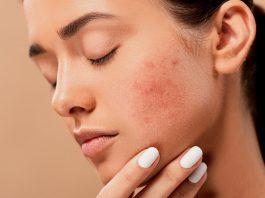 Skincare trị mụn ẩn hiệu quả chỉ trong 6 bước