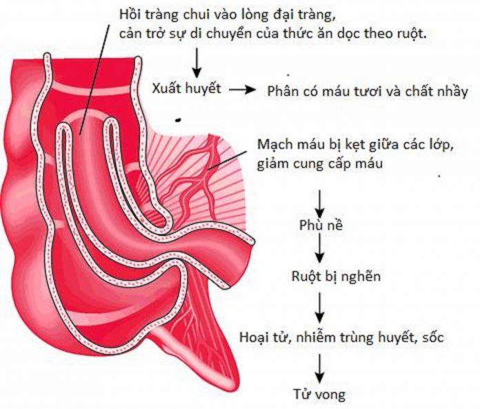 Hiện tượng lồng ruột thường gặp ở trẻ nhỏ (Nguồn: Internet)