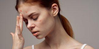Vi khuẩn P.acnes cũng là yếu tố làm da nổi mụn (Nguồn: internet)