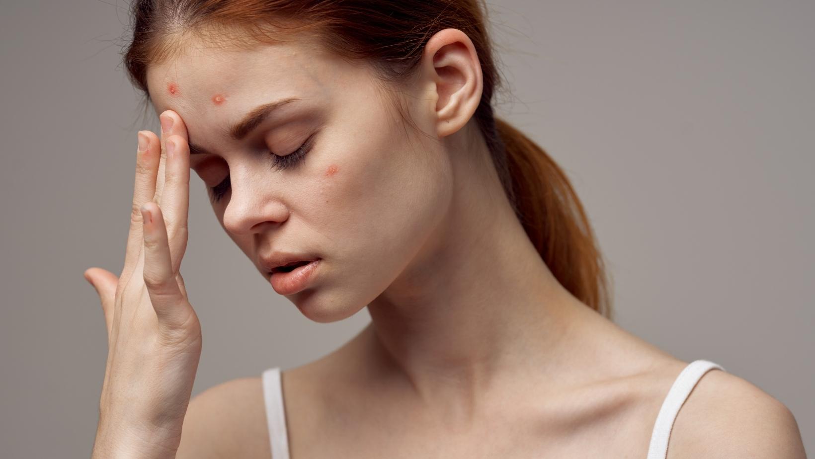 Vi khuẩn P.acnes cũng là yếu tố làm da nổi mụn (Nguồn: internet)