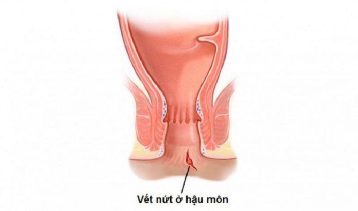 Nứt kẽ hậu môn táo bón kéo dài (Nguồn: Internet)