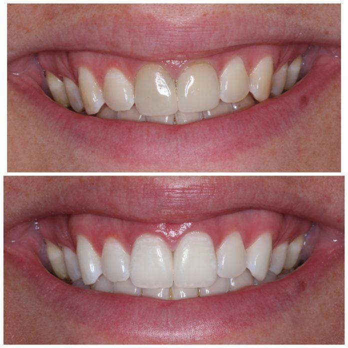Bột đánh trắng răng Eucryl Toothpowder xử lí tình trạng răng ố vàng và xỉn màu (Nguồn: Internet).