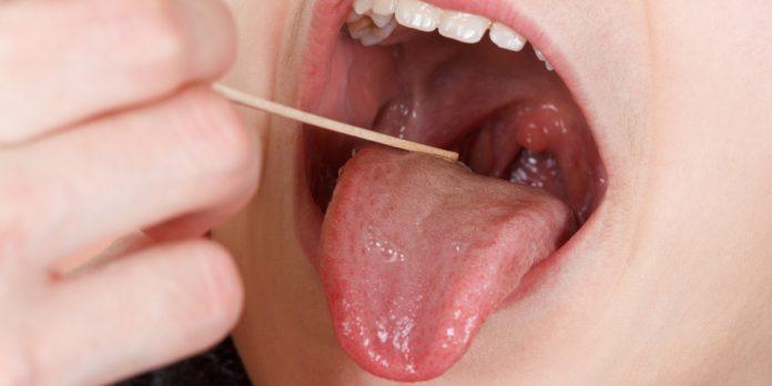Ung thư miệng hầu cũng là dạng ung thư nằm trên lưỡi (gốc lưỡi) (Ảnh: Internet)