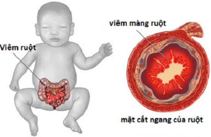 Viêm ruột hoại tử (Nguồn: Internet)