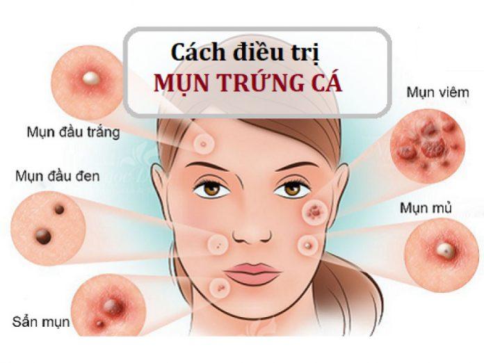 Mụn trứng cá biểu hiện đa dạng và cách điều trị cũng đòi hỏi sự kiên nhẫn (nguồn: internet)