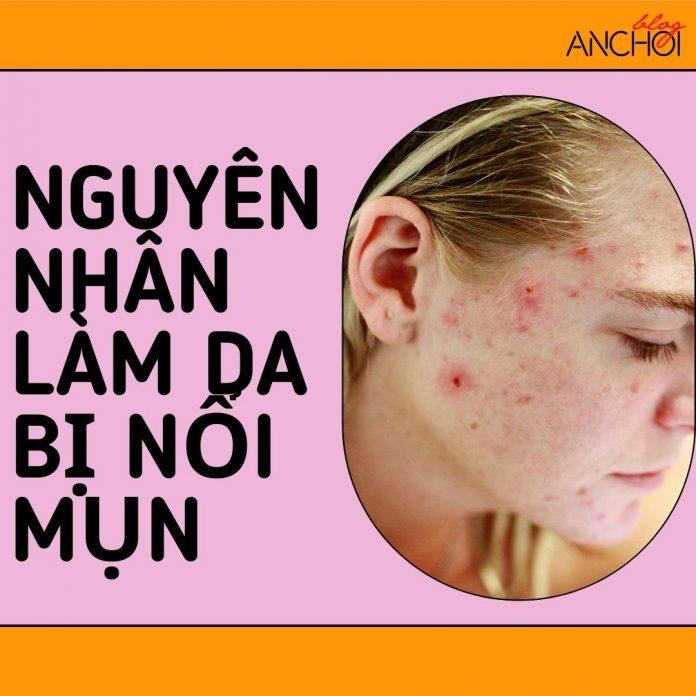 Có rất nhiều nguyên nhân làm da bị nổi mụn các nàng nên tìm hiểu để khắc phục nhá (nguồn: BlogAnChoi)