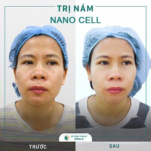 Đông Á áp dụng công nghệ Nano Cell điều trị nám da (Nguồn: Đông Á)