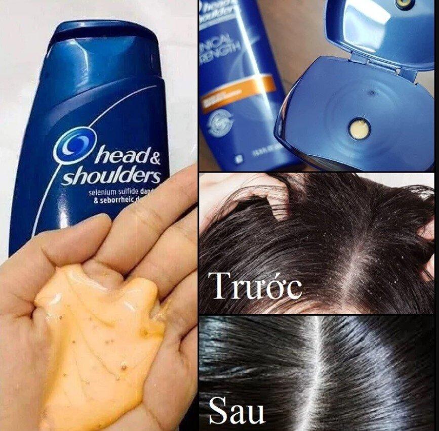 Hình ảnh da đầu trước và sau khi sử dụng dầu gội Head And Shoulders Clinical Strength. (Nguồn: internet)