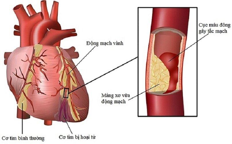 Bệnh ở động mạch vành có thể gây đau ngực (Ảnh: Internet).