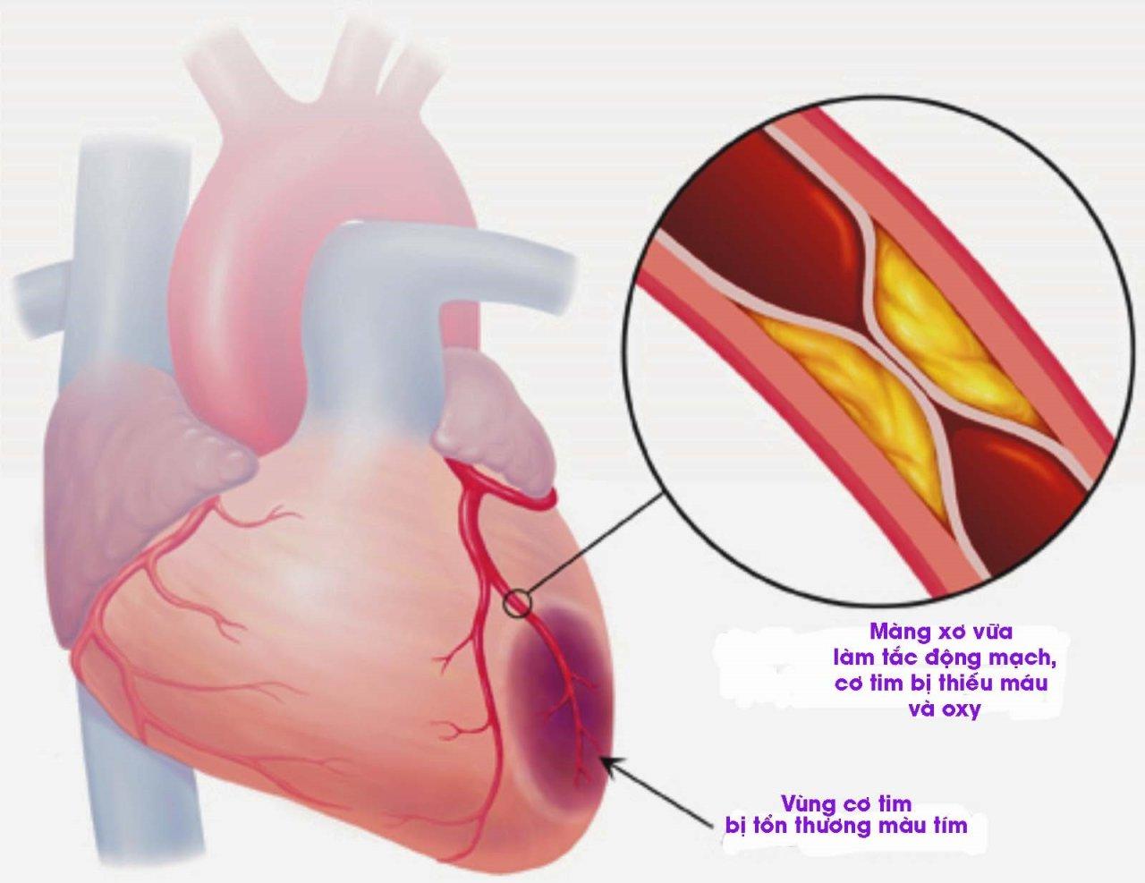Đau ngực do tắc mạch vành trong nhồi máu cơ tim (Nguồn: Internet).