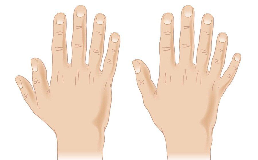 6 ngón tay là do gene trội đó nhé (Ảnh: Internet)