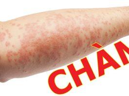 Người bị bệnh chàm da cần lưu ý gì đối với vaccine COVID-19?