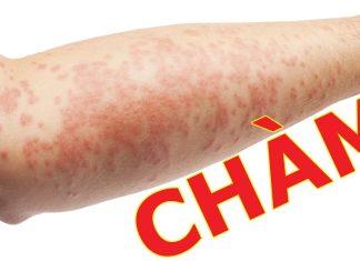 Người bị bệnh chàm da cần lưu ý gì đối với vaccine COVID-19?