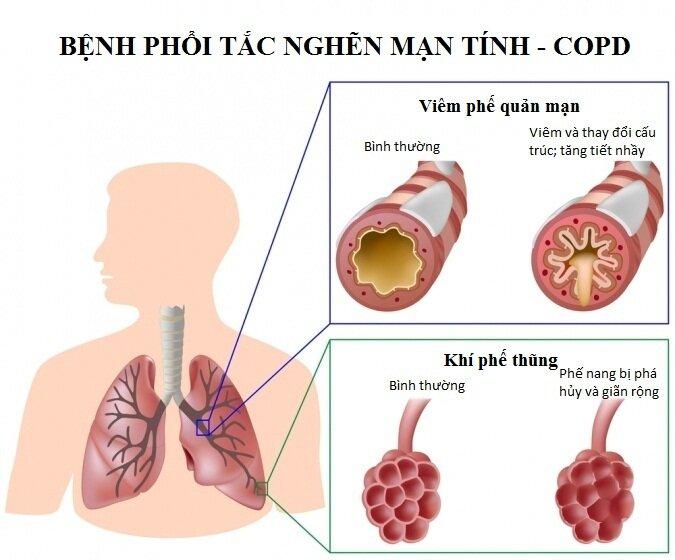 So sánh phổi bình thường và phổi bị COPD (Ảnh: Internet).