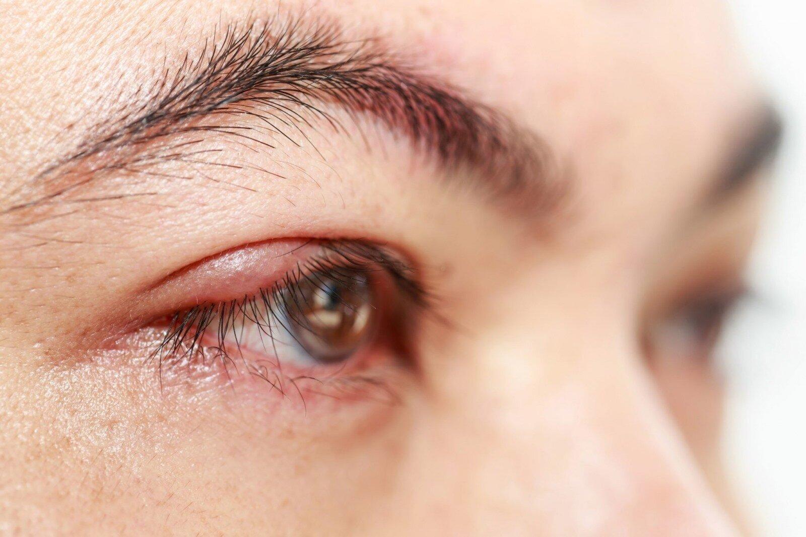 Lẹo mắt là tình trạng nhiễm trùng ở mắt (Ảnh: Internet).