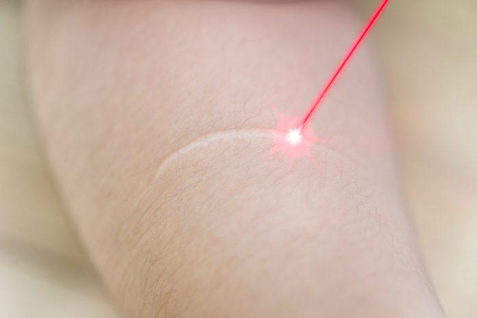 Điều trị sẹo bằng liệu pháp Laser (Nguồn: Internet).