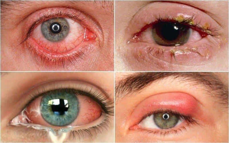 Đây là một trong số những vấn đề về mắt nghiêm trọng nhất (Ảnh: Internet).