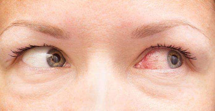 Khô mắt là bệnh lý về mắt thường xuyên xảy ra (Ảnh: Internet).