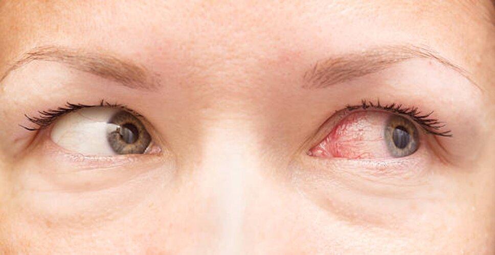 Khô mắt là bệnh lý về mắt thường xuyên xảy ra (Ảnh: Internet).