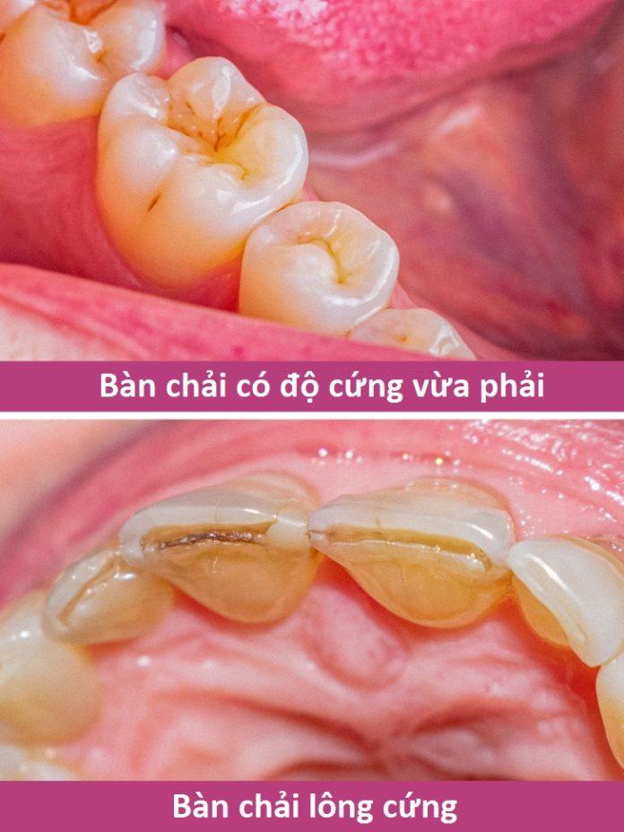 Bàn chải lông cứng gây hại cho răng nhiều hơn bạn tưởng (Ảnh: Internet)