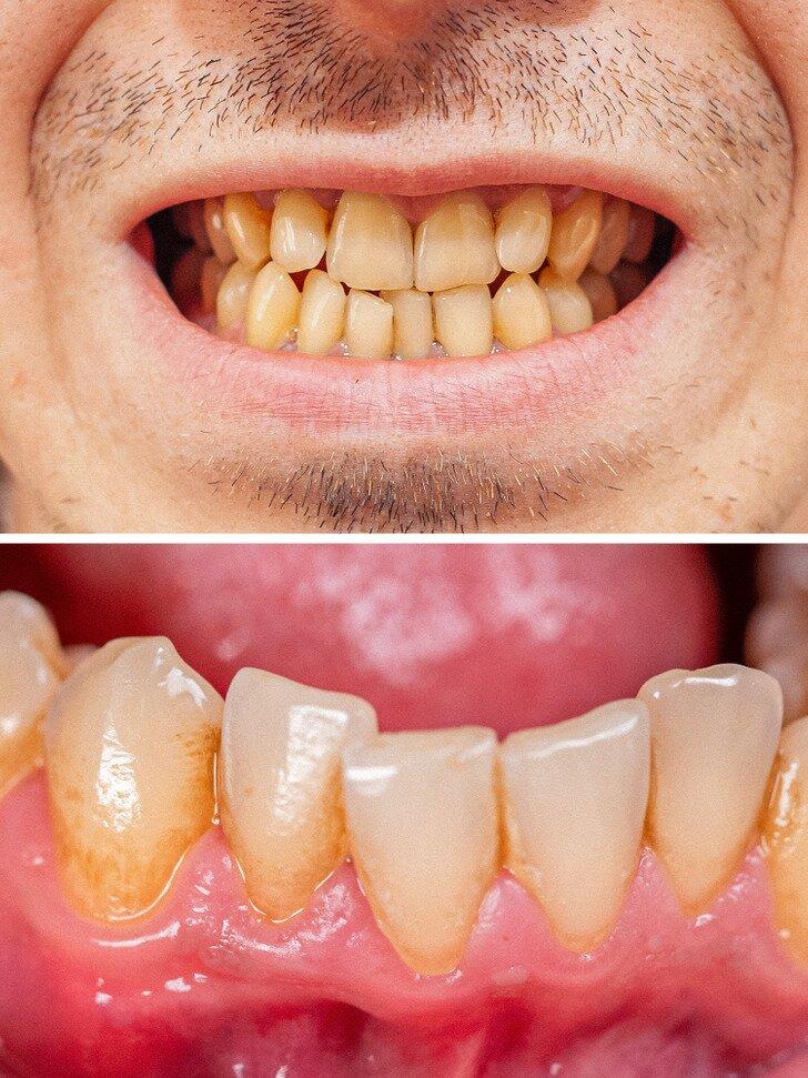 Chải răng quá nhiều hoàn toàn không tốt cho răng miệng (Ảnh: Internet)