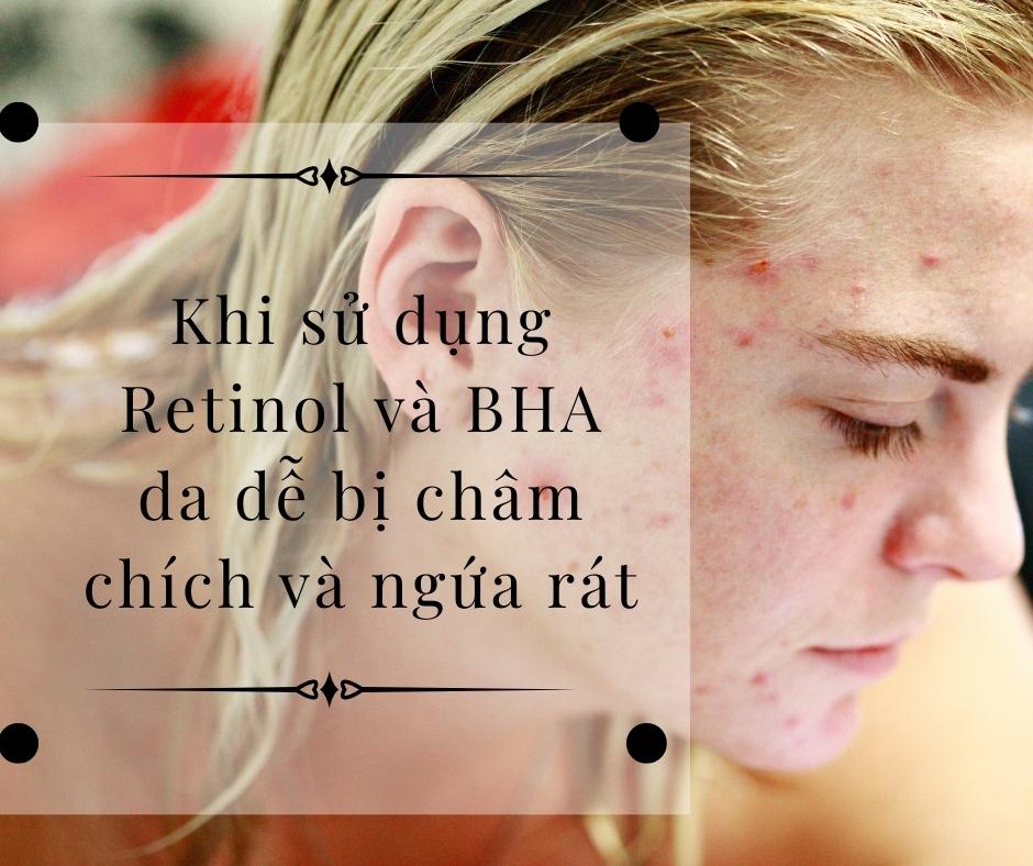 Một trong những nhược điểm khi dùng BHA và Retinol là da có thể bị châm chích, nóng rát khi này bạn cần giảm dần tần suất sử dụng lại cho da được thích nghi tốt hơn (nguồn: internet)