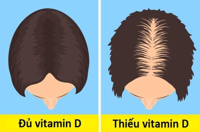 Dấu hiệu thiếu vitamin D (Ảnh: Internet)