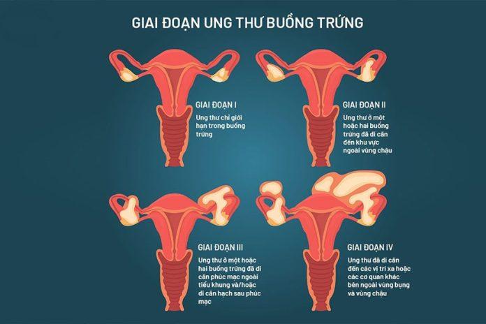 Ung thư buồng trứng: Triệu chứng, nguyên nhân, chẩn đoán và điều trị ai có nguy cơ mắc ung thư buồng trứng béo phì chẩn đoán ung thư buồng trứng chất béo chế độ ăn dấu hiệu ung thư buồng trứng Điều trị điều trị ung thư buồng trứng gia đình làm thế nào để giảm nguy cơ mắc ung thư buồng trứng mang thai Nguyên nhân nguyên nhân ung thư buồng trứng phẫu thuật phục hồi tránh thai triệu chứng triệu chứng ung thư buồng trứng ung thư ung thư buồng trứng