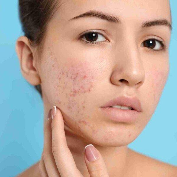 Làn da khi đang trong quá trình trị mụn là làn da có nguy cơ kích ứng nhất! (Ảnh: internet)