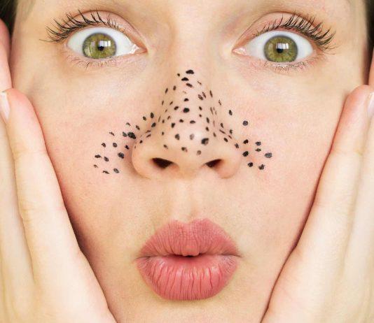 Gợi ý chu trình chăm sóc da trị mụn đầu đen và những lưu ý cần phải biết Mụn đầu đen (Ảnh: Internet)