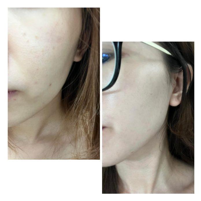 Da mặt mình trước và sau khi uống combo 2 sản phẩm. (Nguồn: BlogAnChoi)
