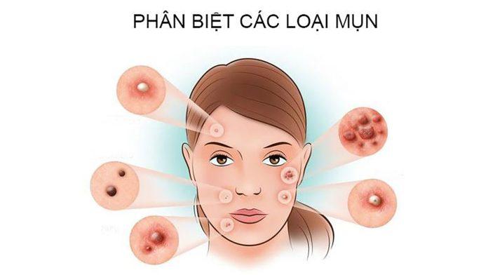 Mụn trứng cá, mụn mũ, mụn đầu đen, mụn bọc (Ảnh: Internet).