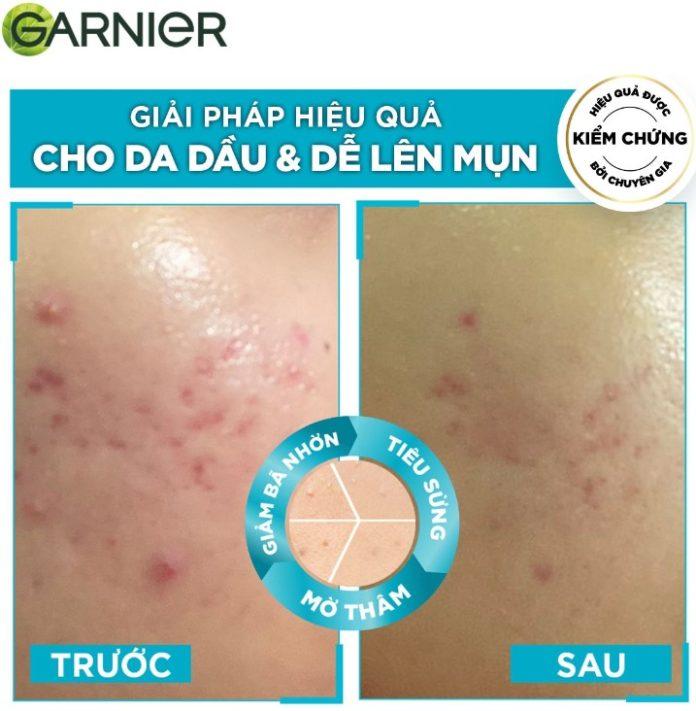 Khả năng giảm mụn của serum Garnier Anti-Acnes