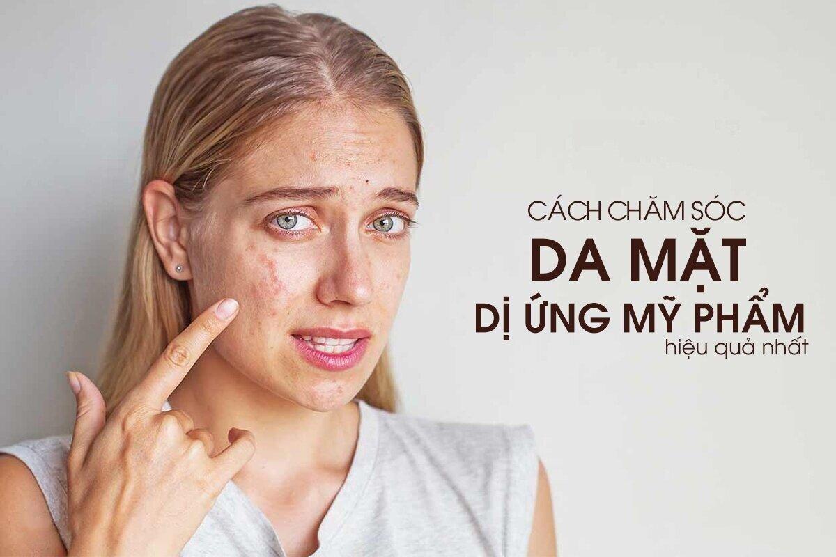 Triệu chứng của dị ứng da mặt (Nguồn: Internet)