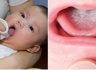 Thói quen gây ra tưa miệng ở trẻ và cách phòng tránh tưa miệng cho bé