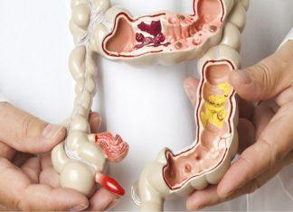 Trĩ nội do nguyên nhân gì? Triệu chứng và cách phòng ngừa ra sao?