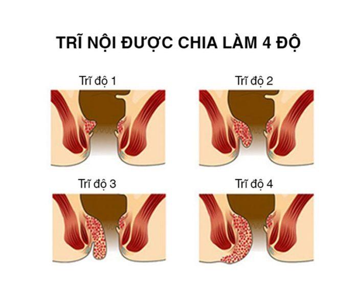 Nguyên nhân gây ra trĩ nội (Nguồn: Internet)