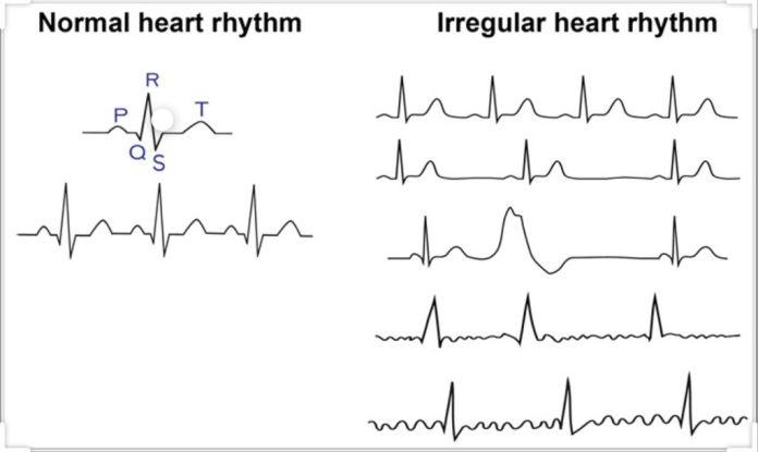 Nhịp tim thất thường là một dấu hiệu sớm của bệnh tim (Ảnh: Internet)