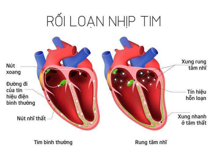 Rối loạn nhịp tim (Nguồn: Internet)