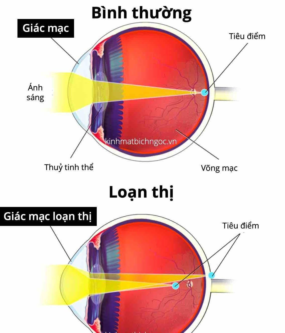 Mắt bị loạn thị so với mắt bình thường (Ảnh: Internet)