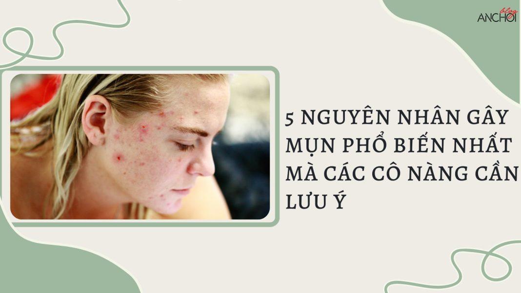 5 nguyên nhân gây mụn phổ biến nhất (nguồn: BlogAnChoi)