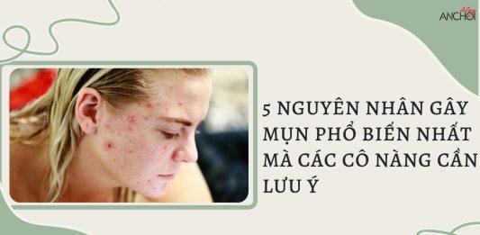 5 nguyên nhân gây mụn phổ biến nhất (nguồn: BlogAnChoi)