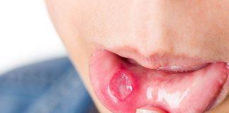 Quản lý tình trạng loét miệng ở bệnh nhân ung thư (Nguồn: Internet)