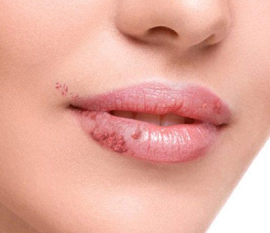 Sùi mào gà ở miệng (Nguồn: Internet)